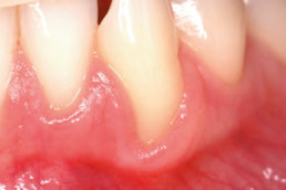 recession defect of Miller Class II was observed in the lower right canine