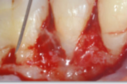 application of hyadent bg in dental surgery