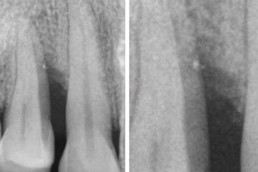 dental regeneration with hyadent bg