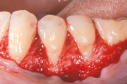 dental surgery Open flap (CAF protocol)