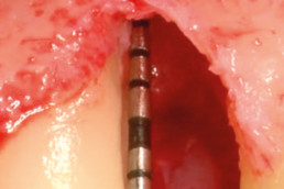 Situation after flap preparation and thorough degranulation of defect