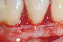 oral surgery with hyadent bg