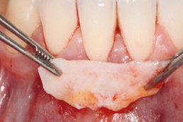 Connective tissue graft (CTG) used for Gingival recession