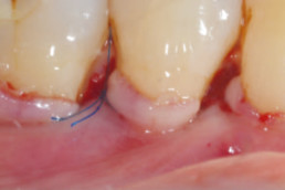 The wound is closed by coronally advancing the flap margin (without tension) by at least 1,5 mm to the cementoenamel junction