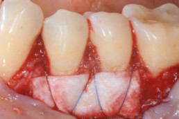 Suturing on tooth surface of the folded Smartbrane coated with xHyA gel