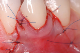 dental surgery with hyadent bg