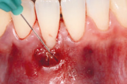 dental surgery with hyadent bg