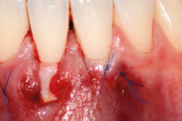 Connective tissue graft fixed in the tunnel