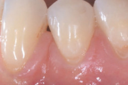 dental regeneration with hyadent bg