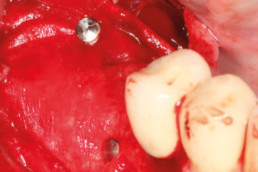 dental surgery with smartbrane and hyadent BG