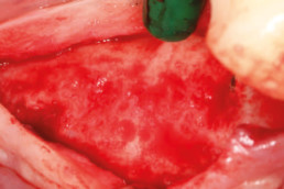 bone regeneration in dental surgery with bone graft and hyaluronic acid gel, hyadent BG