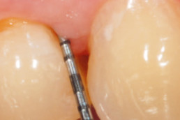 Significant reduction of probing depth after dental surgery with hyadent bg