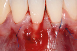 oral surgery with hyadent bg