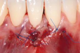dental surgery with xHyA gel on laterally closed tunnel